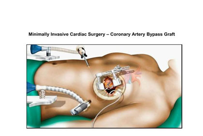 Coronary-Bypass-without-Opening-Chest