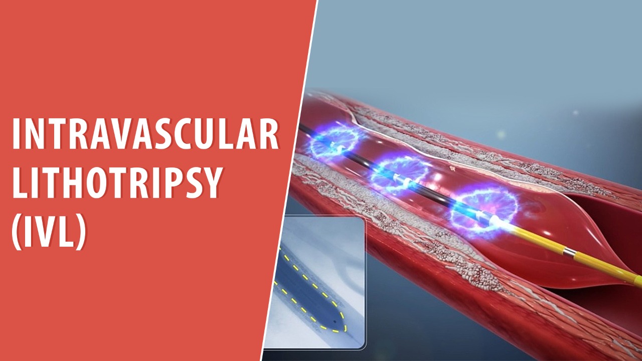 Intravascular-lithotripsy
