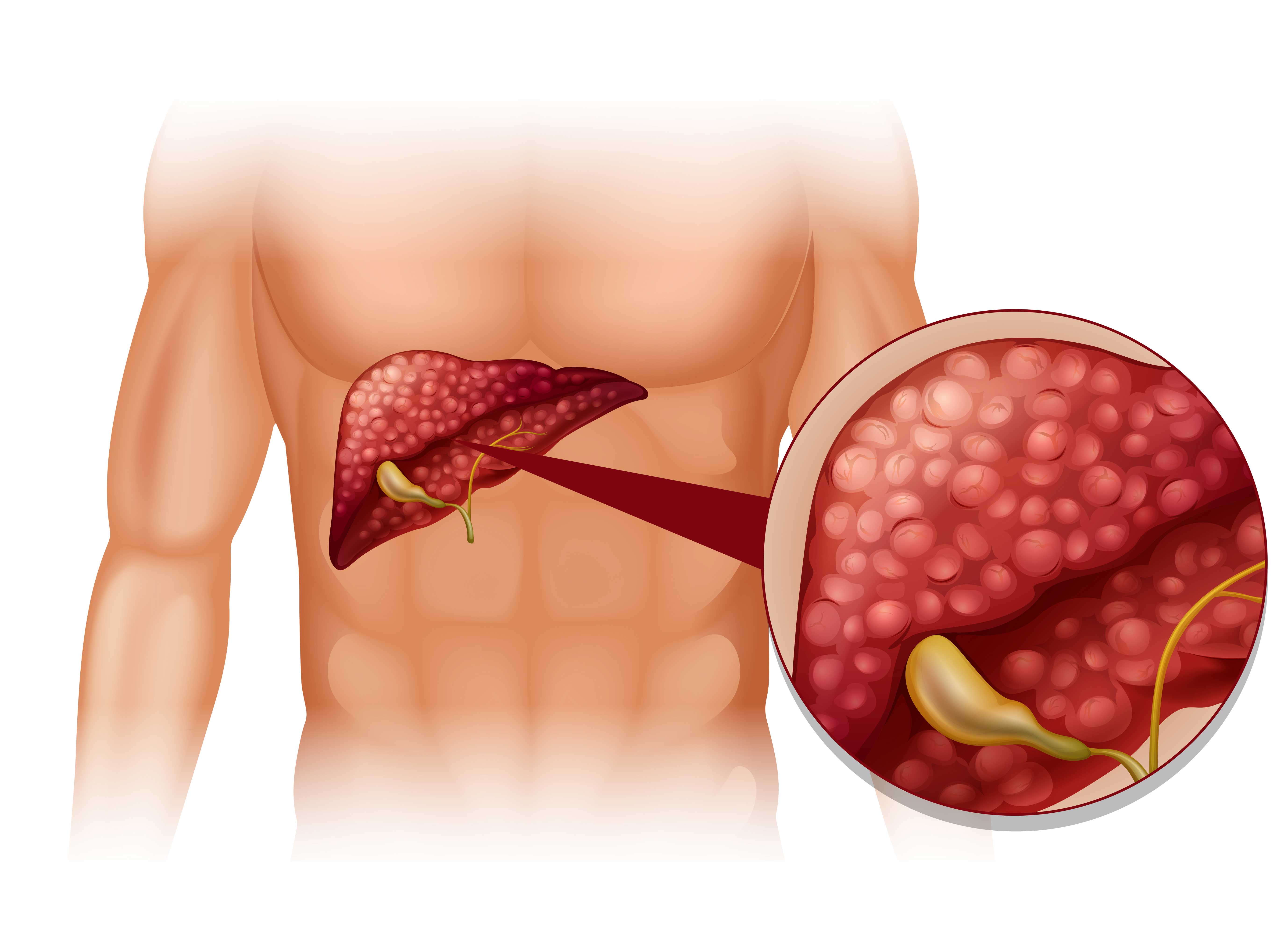 Liver-cirrhosis