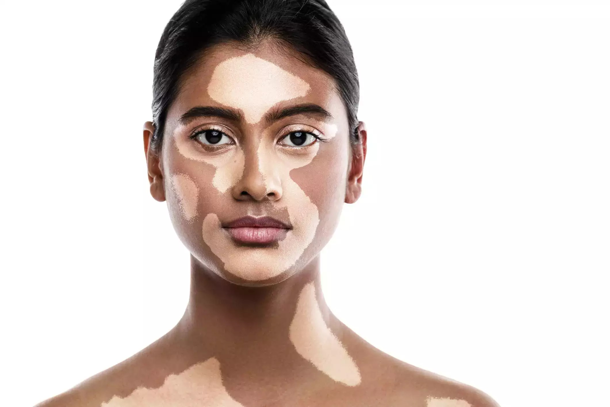 Vitiligo