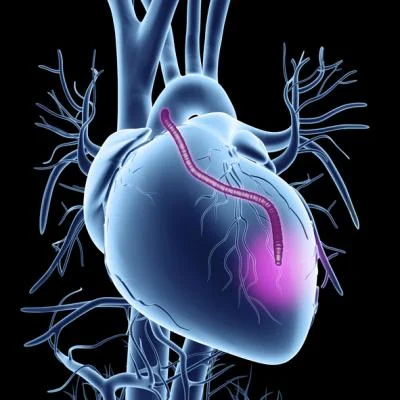multi-arterial-cabg-long-term