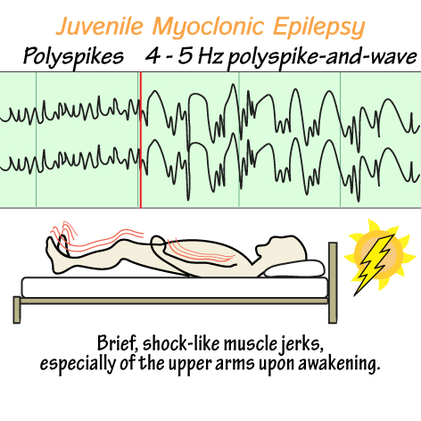 Juvenile Myoclonic Epilepsy (JME)